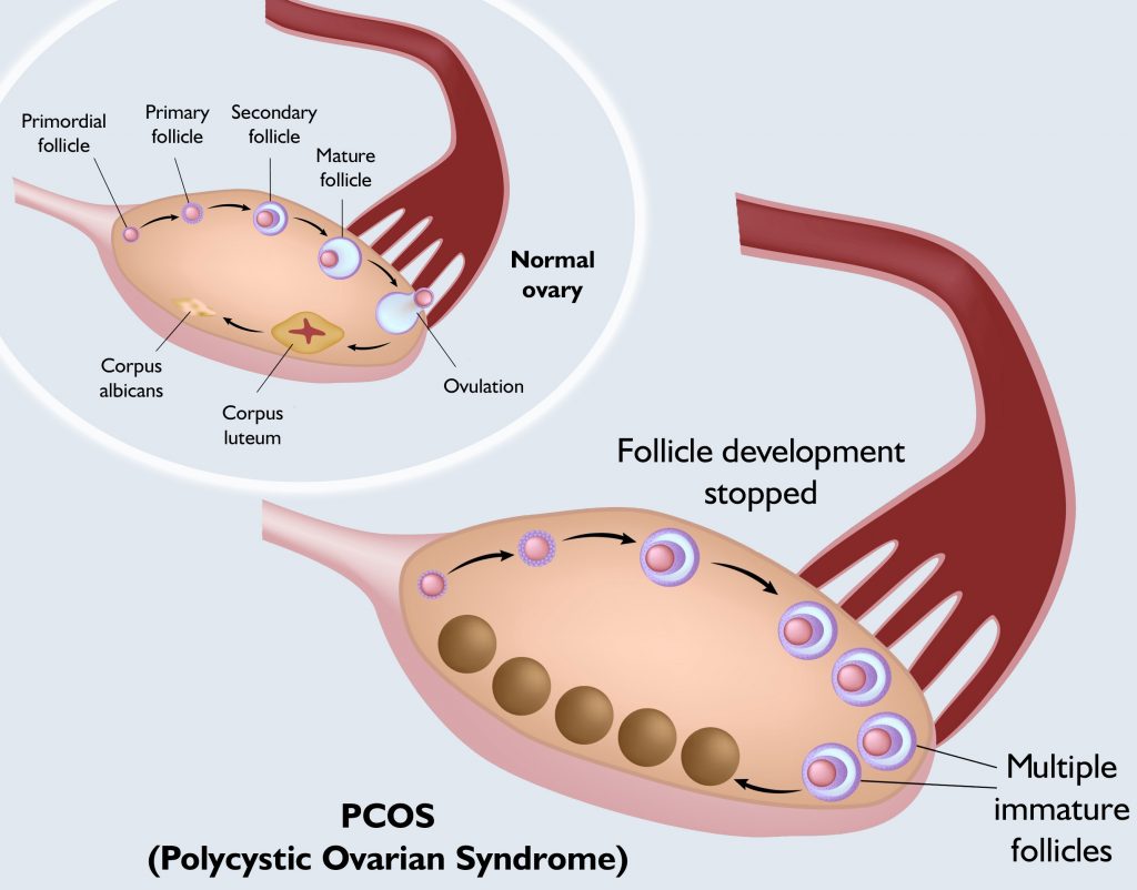 PCOS4
