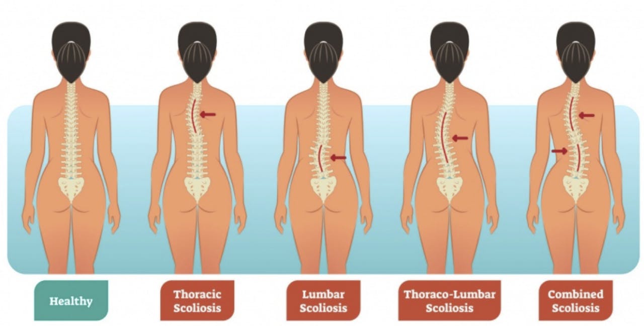 Scoliosis2
