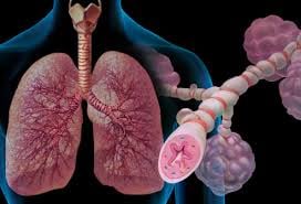 asthma