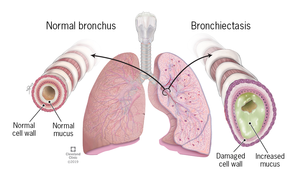bronchiectasis