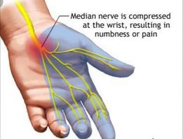 carpaltunnel3