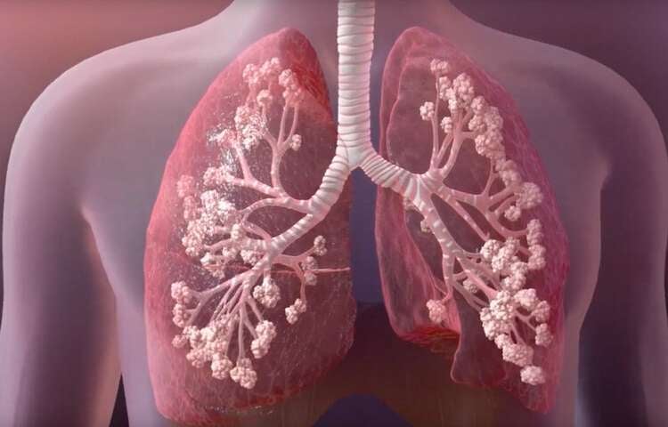 cysticfibrosis