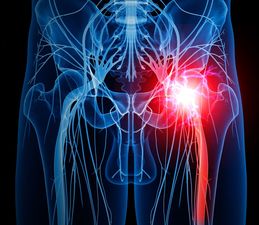 deepglutealsyndrome4