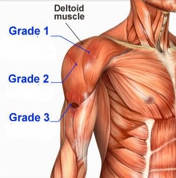 deltoid3