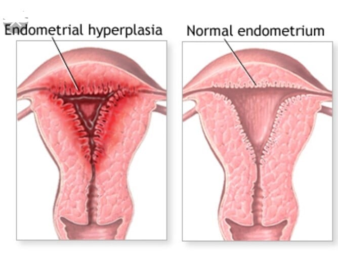 endo2
