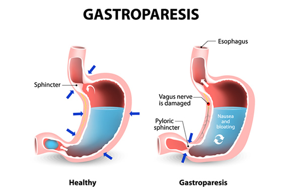 gastroparesis2