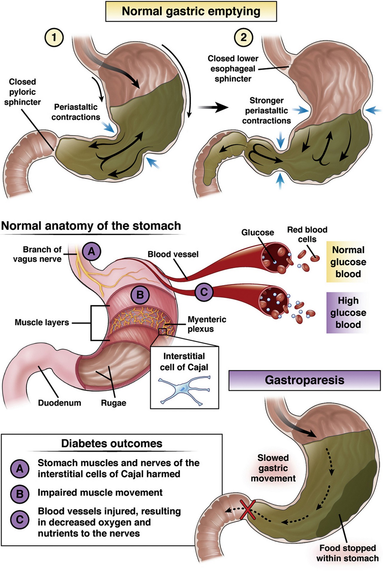 gastroparesis3