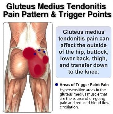 glutealtendinopathy