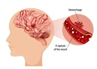 haemorrhagicstroke