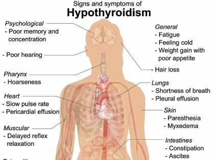 hypothyroidism