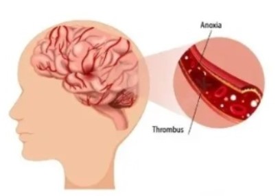 ischaemic stroke