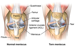 meniscus4