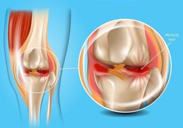 meniscus6