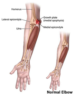 normal vs little league elbow