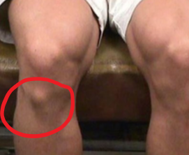osgoodschlatter3