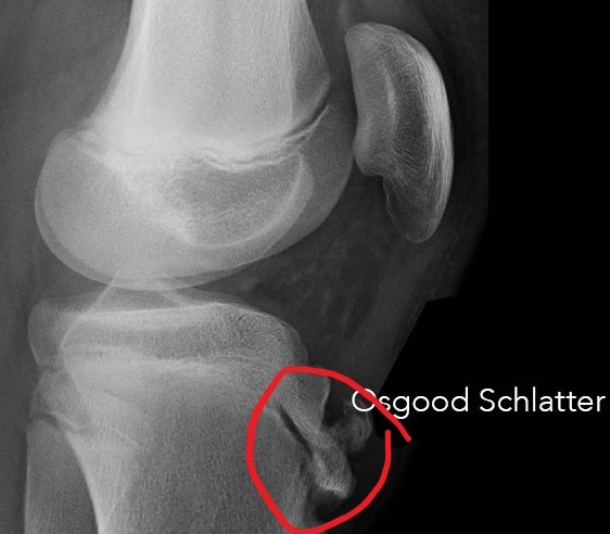 osgoodschlatter4