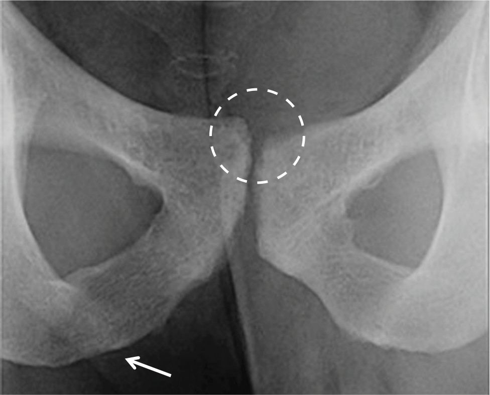 osteitispubis2