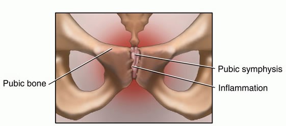 osteitispubis4
