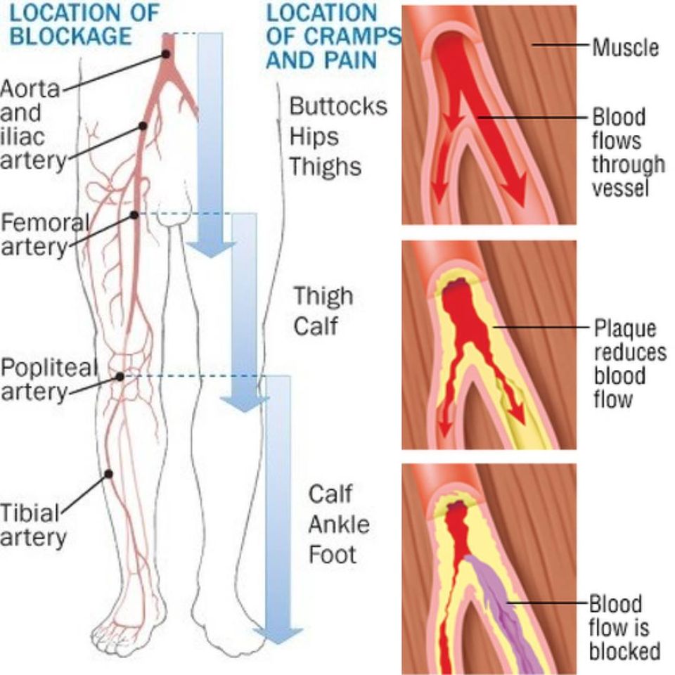 peripheralarterydisease2