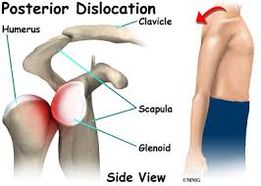 postshdislocation