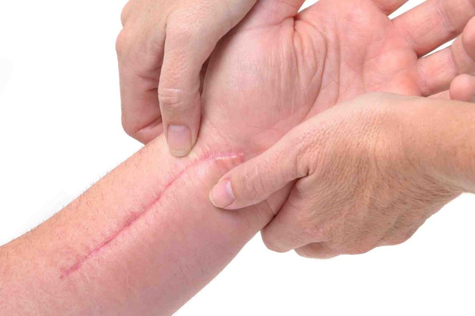 scars4