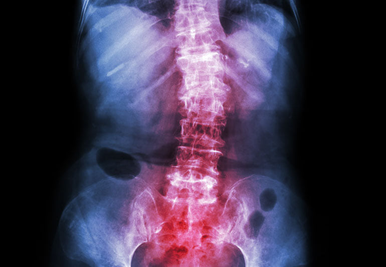scoliosis10