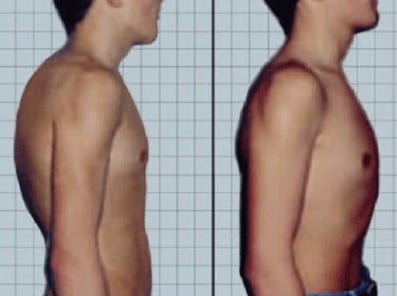 scoliosis3