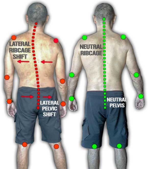 scoliosis6