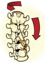 scoliosis8