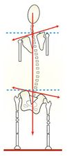 scoliosis9