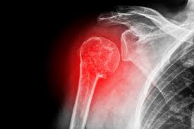 shdislocation3