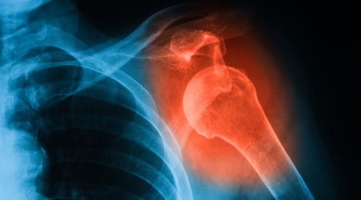 shdislocation5