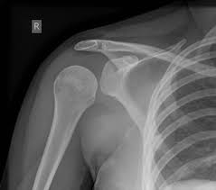 shdislocation7post