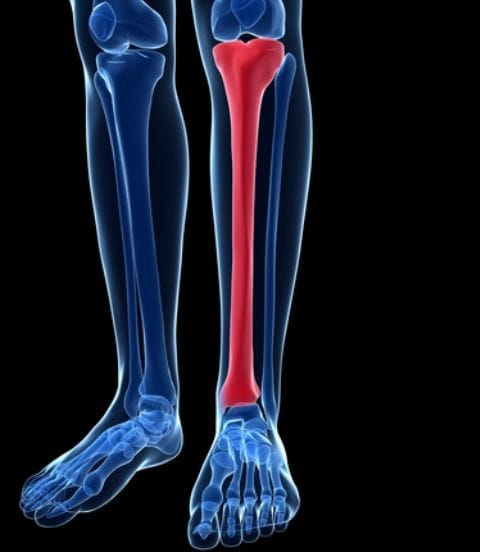 shinsplints3