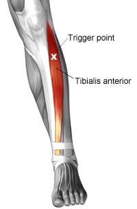 shisplints4