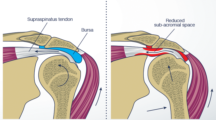 shoulderImpingement 00