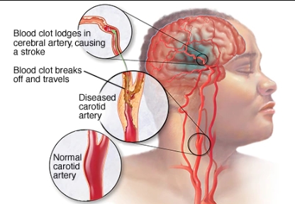 stroke2