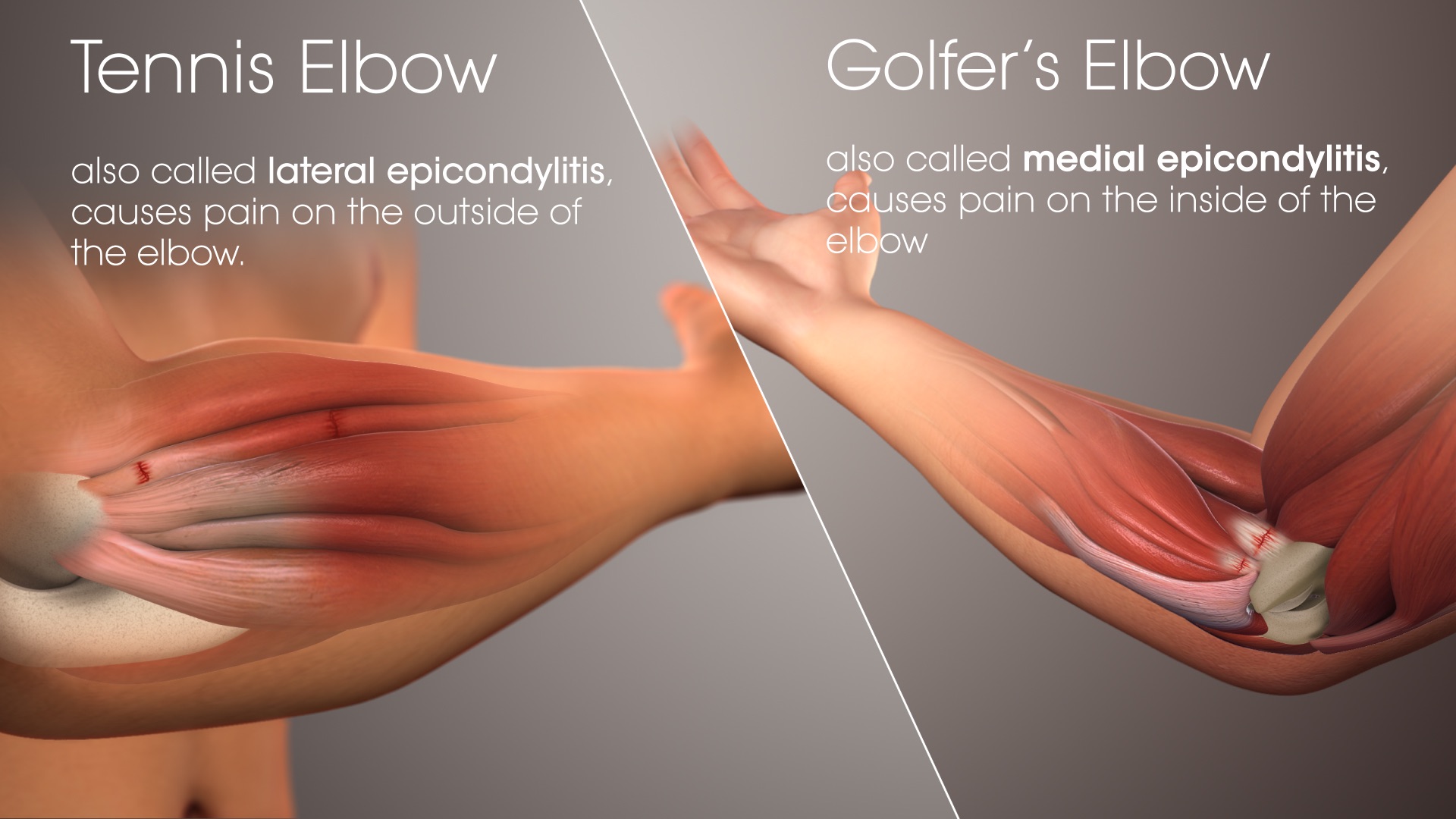 tennis golf elbow