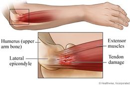 tenniselbow2