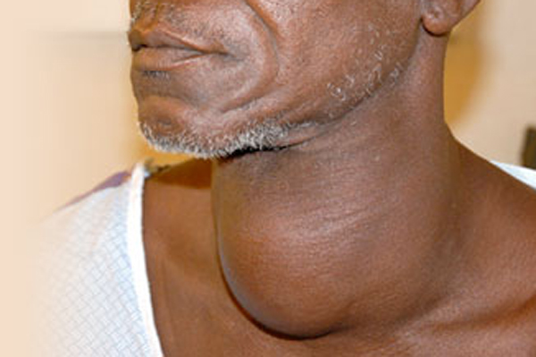 thyroid3