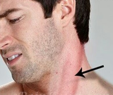 torticollis2