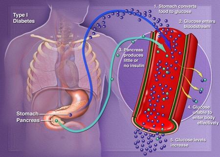 type1diabetic2