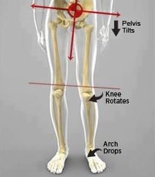 valgus