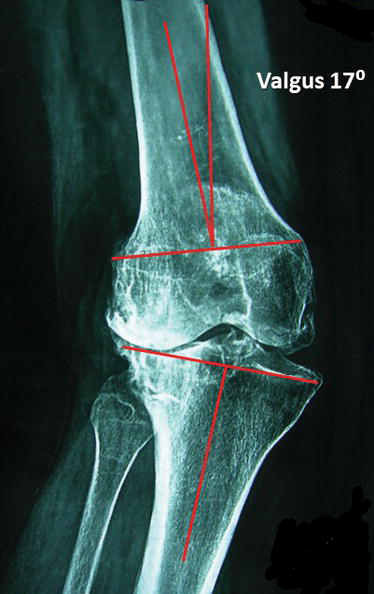 valgus5